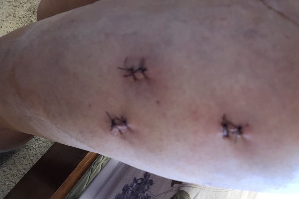 Hip Surgery Stitches